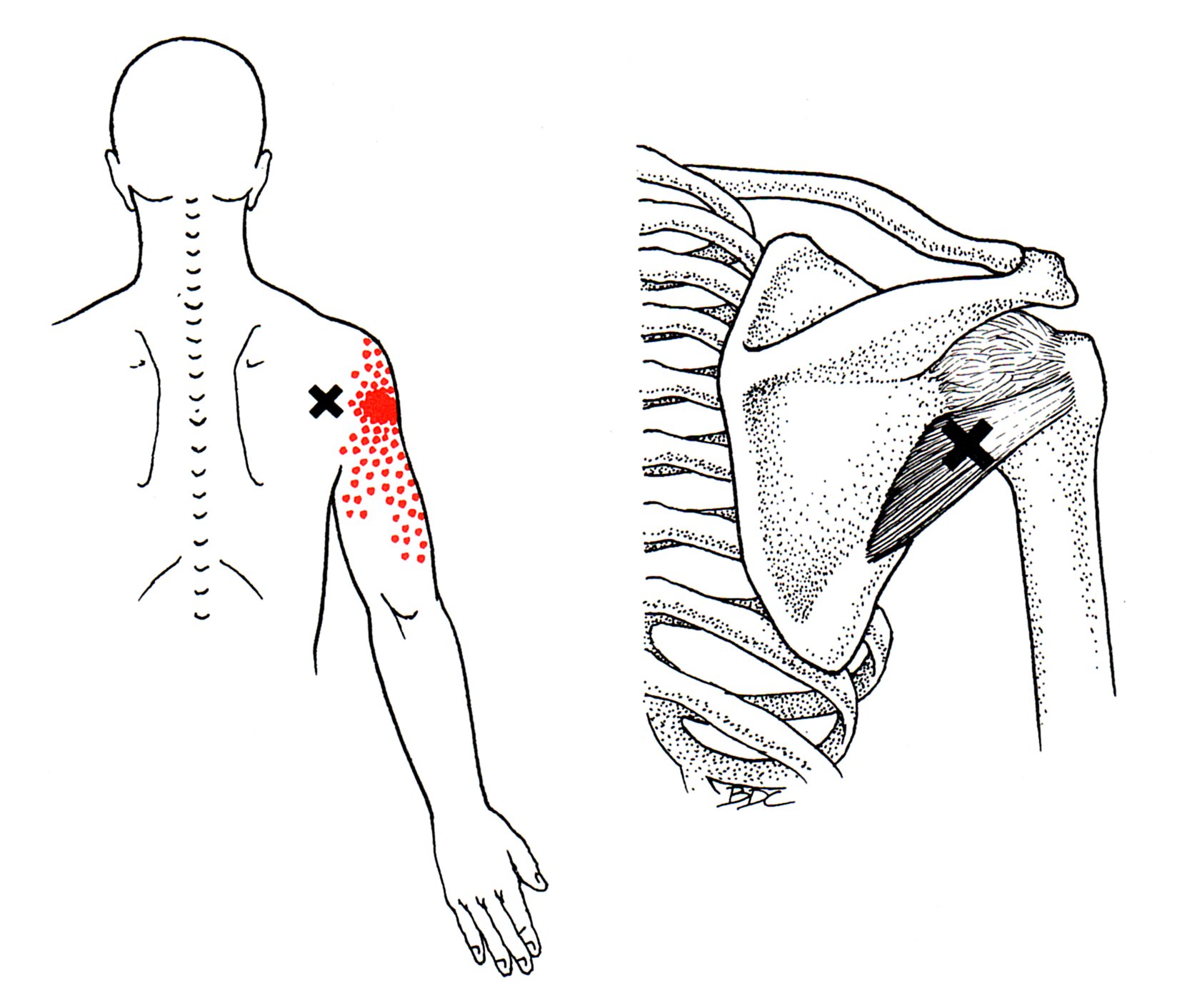 Neben-Schultergelenksmuskel | The Trigger Point & Referred Pain Guide
